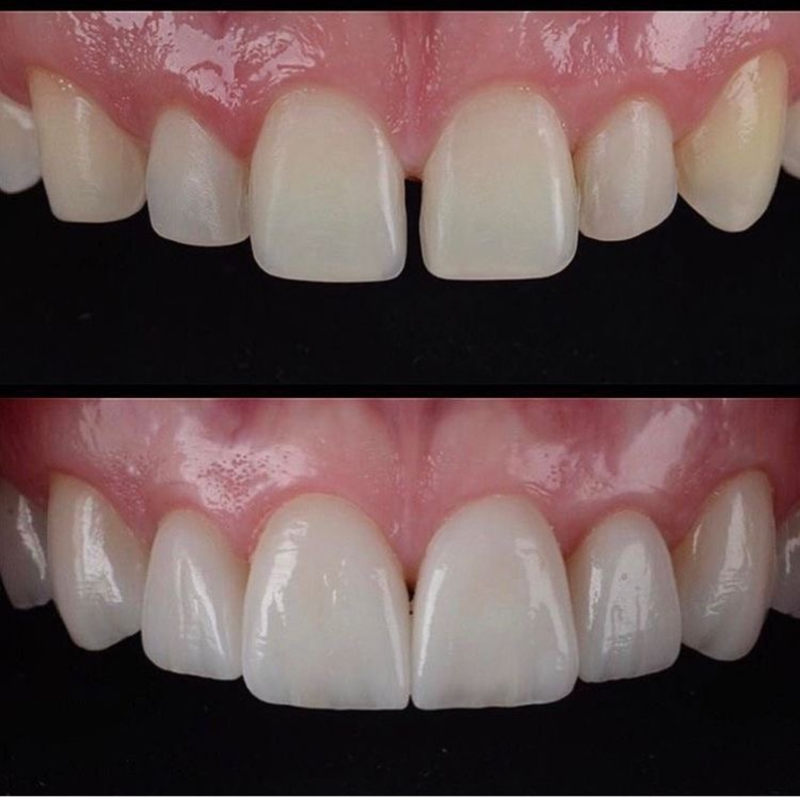 Antes y después de tratamiento estético dental