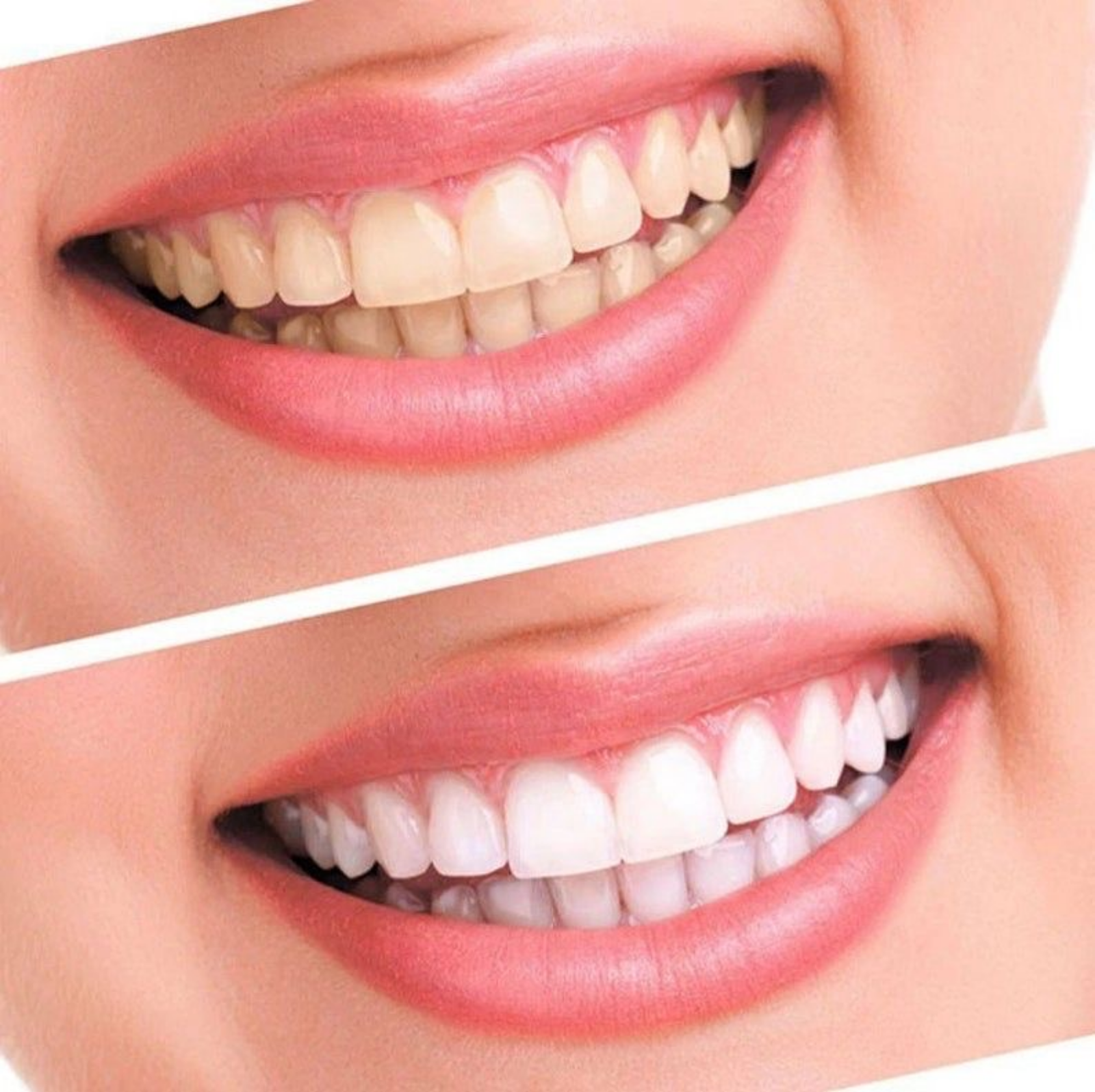 Antes y después de restauración de sonrisa