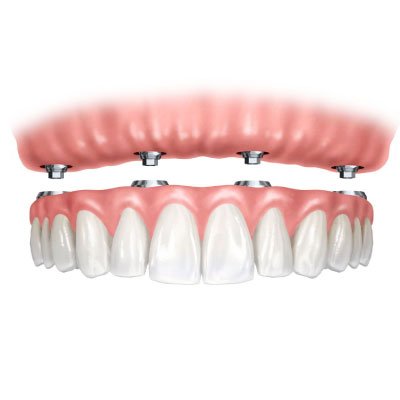 All-on-4 — Todo sobre 4 implantes