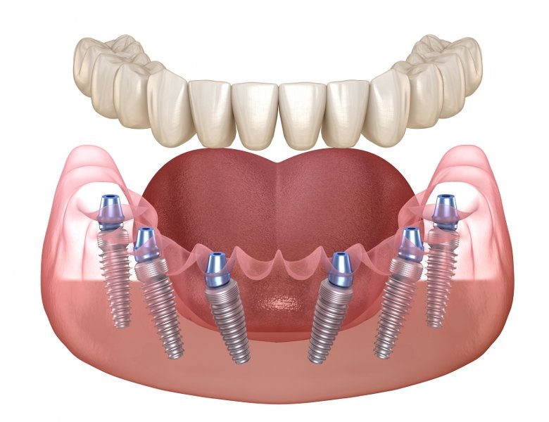 All-on-6 — Todo sobre 6 implantes