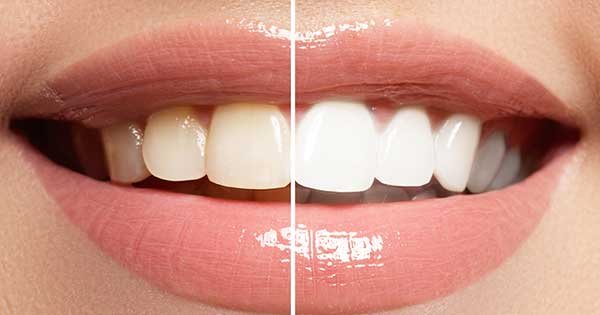 Blanqueamiento dental