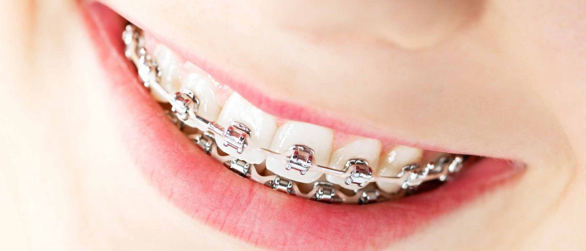 Brackets metálicos o convencionales