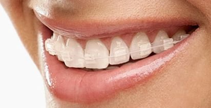 Brackets estéticos