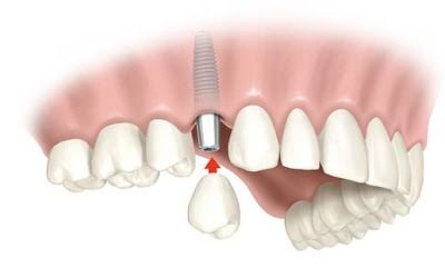 Implantes dentales