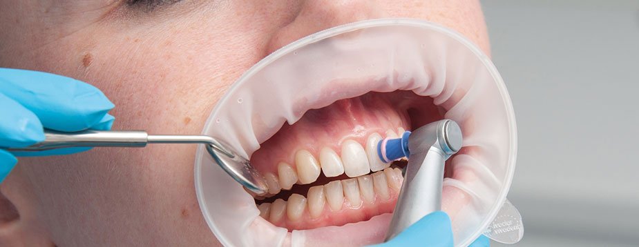 Limpieza dental