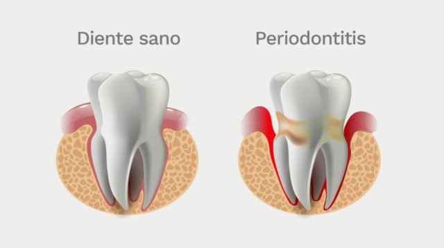 Periodontitis